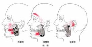 Jaw trigger point